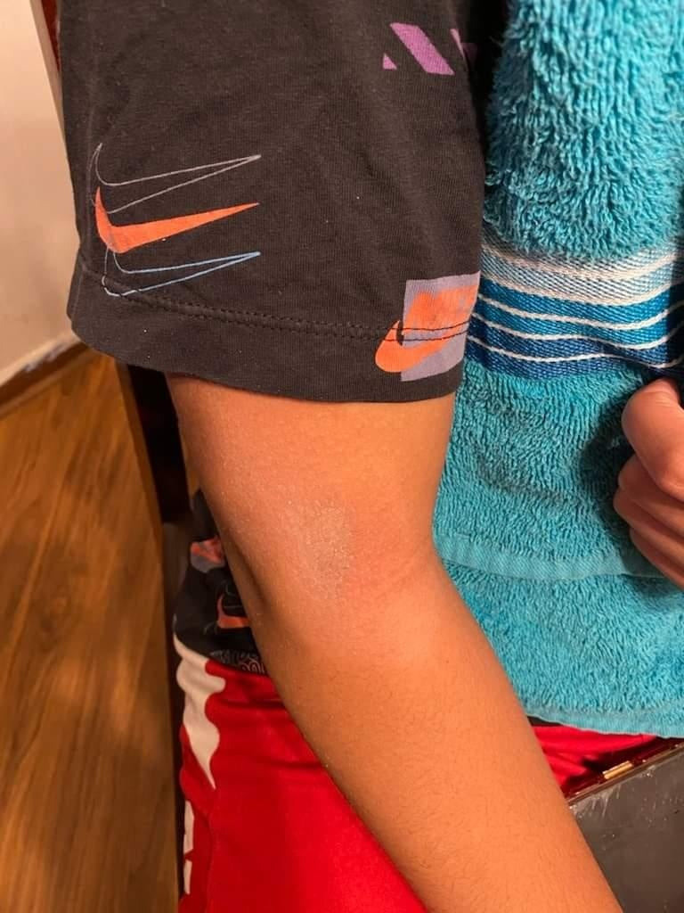 Manage your Eczema with Poseidon Neptune
